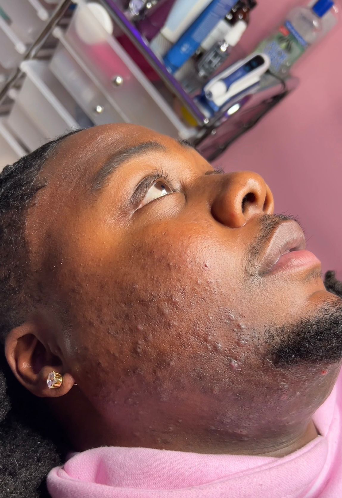A close-up lifestyle shot of a man looking upward, showing significant facial acne and blemishes on his face and neck, wearing a pink shirt and a small gold stud earring in what appears to be a salon or treatment room.